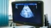 Durerile menstruale nu sunt „normale”. Cum este diagnosticată și tratată endometrioza în R. Moldova
